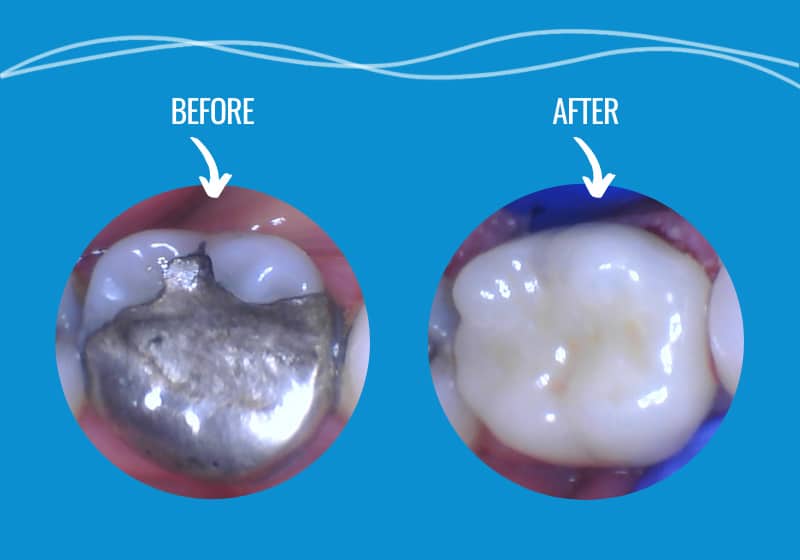 Painless Dental Crown in a Day | Pathway Dentists